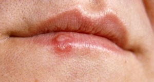 Cold Sores 